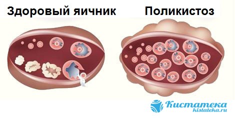 Первые признаки дисфункции органа проявляются уже в период полового созревания