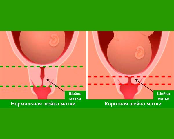 Нормальная и укороченная шейка матки