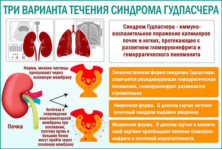 Синдром Гудпасчера: три варианта течения болезни