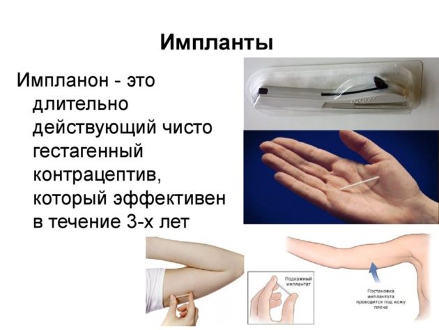 Противозачаточный имплант: цена, описание, отзывы