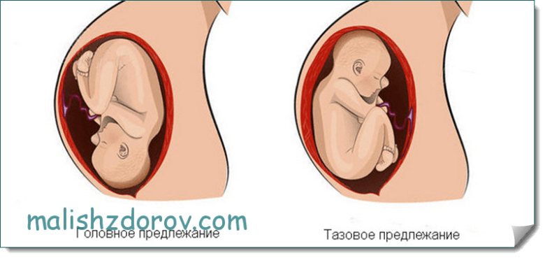 Положение ребенка в утробе