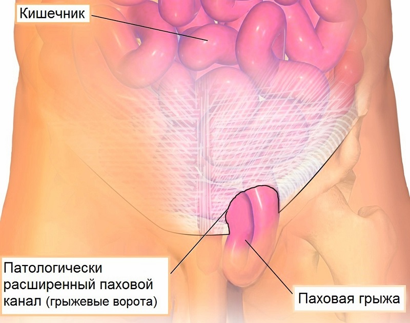 Схема образования паховой грыжи у мужчин