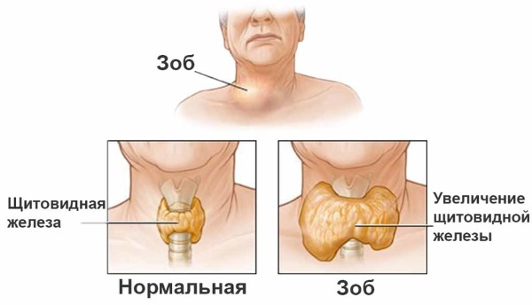 Лапчатка белая, корень. Применение, лечение щитовидной железы. Как приготовить, принимать настой, противопоказания