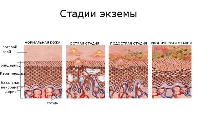  дисгидротическая экзема лечение