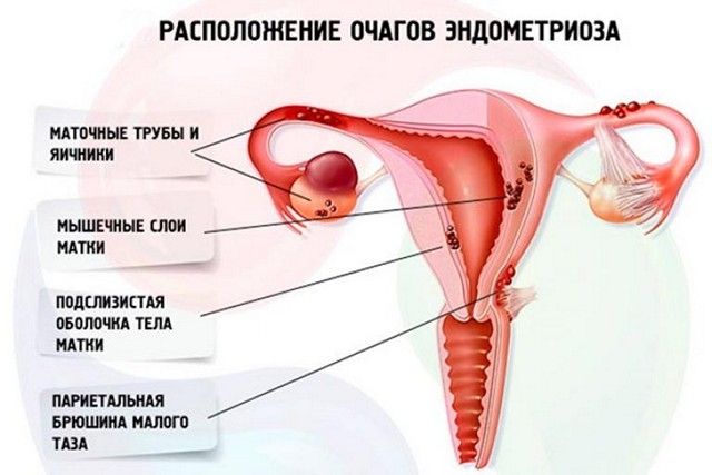 Расположение очагов при Эндометриозе