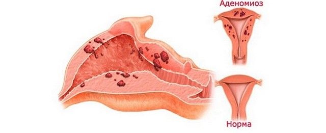 Аденомиоз