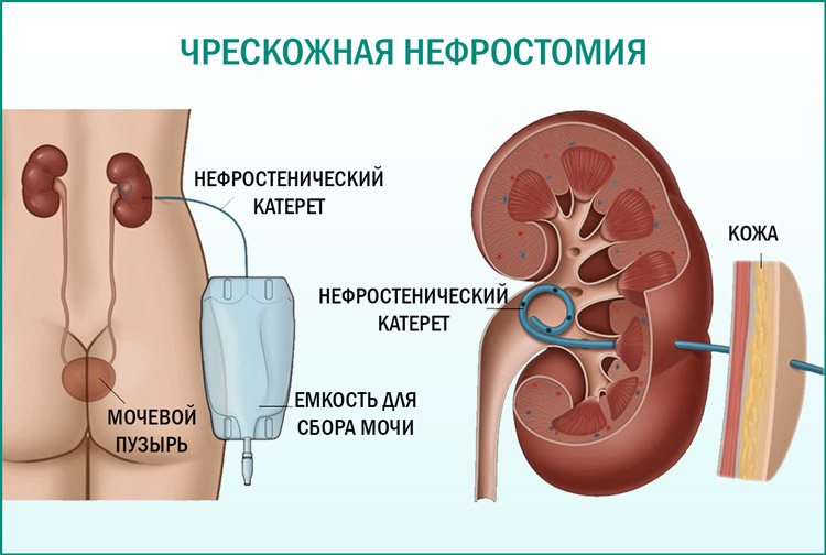 Проведение чрескожной нефростомии