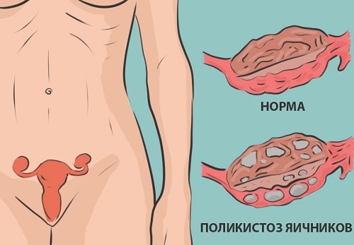 8 причин, почему люди толстеют, даже если реально едят мало калорий: что с этим делать?