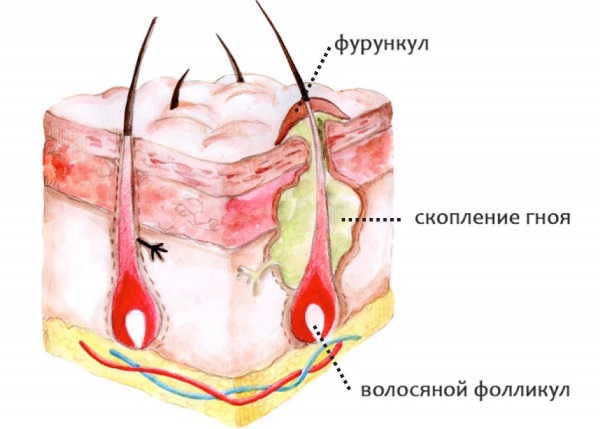 Мази от фурункулов, прыщей на лице, с антибиотиком, вытягивающие гной