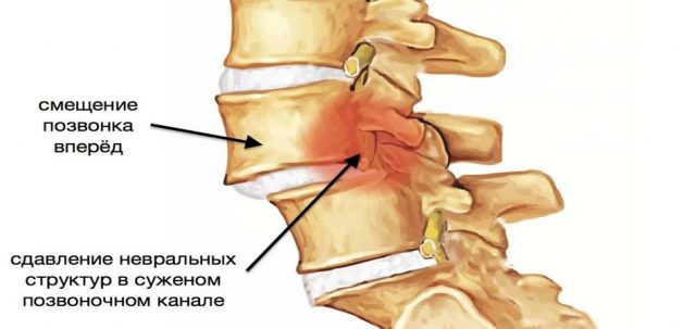 Смещение позвонков