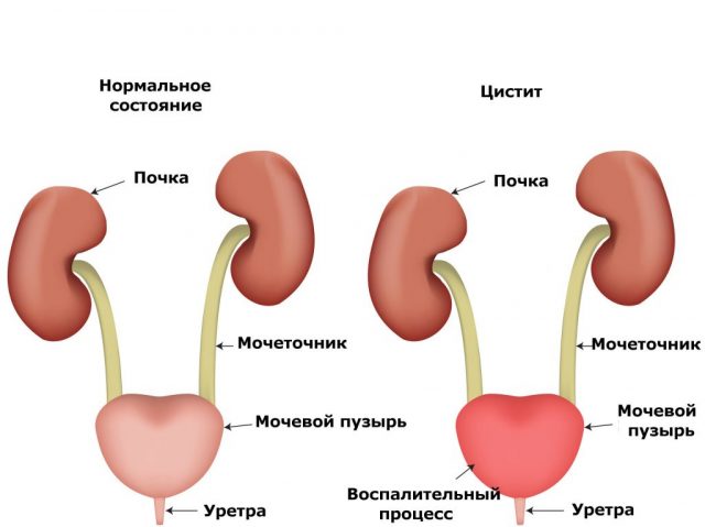 Цистит