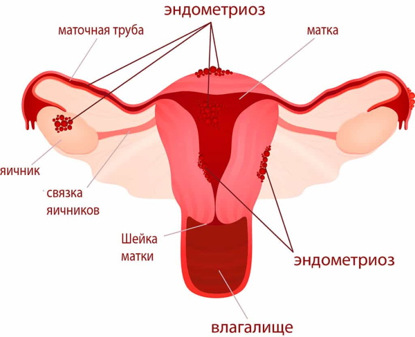 Крапива при кровотечениях маточных. Как заваривать, пить, противопоказания