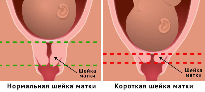 Шейка матки. Фото внутри, строение, норма размеров здоровой при беременности, перед родами, месячными