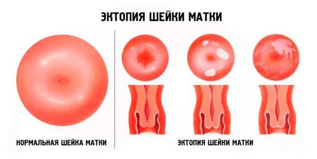 Шейка матки. Фото внутри, строение, норма размеров здоровой при беременности, перед родами, месячными