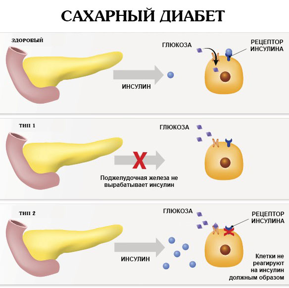 Суточный диурез. Норма, как изменяется, как считать у взрослых и детей