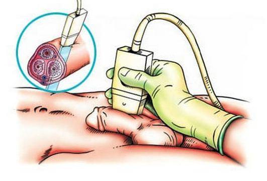 Ультразвуковая допплерография сосудов полового члена