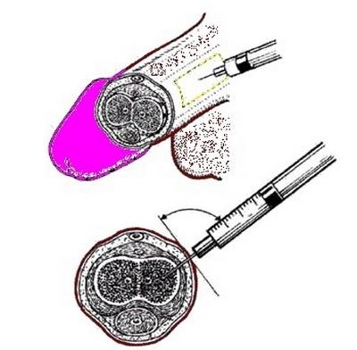 Техника введений интракавернозных инъекций