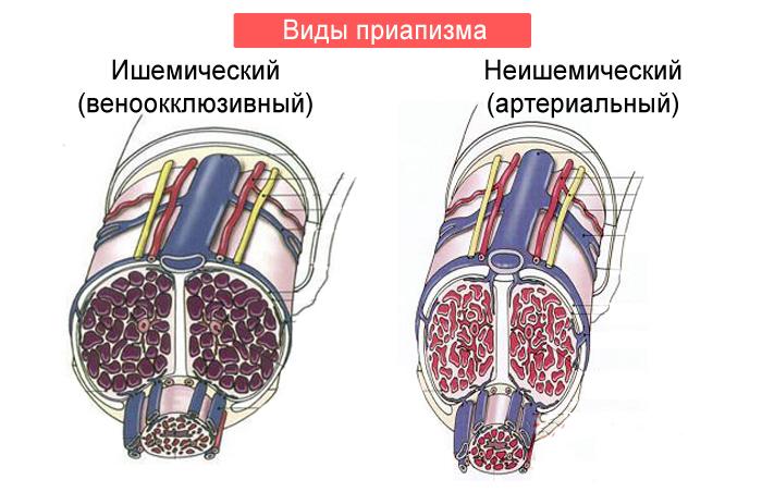 Виды приапизма