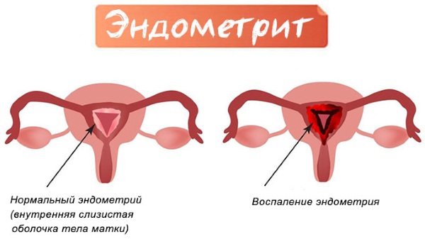 Кремообразные выделения перед месячными, после овуляции, зачатия, при беременности, задержке без запаха с зудом