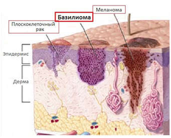 Базалиома кожи