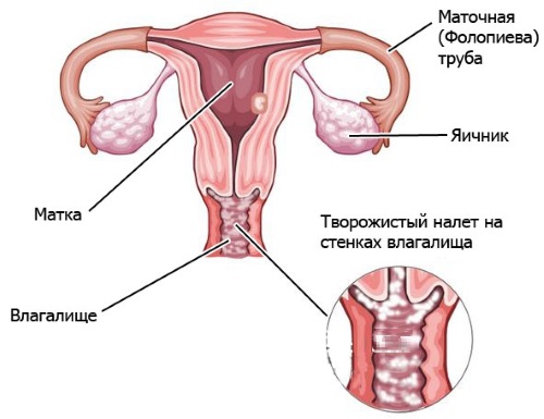 Кремообразные выделения перед месячными, после овуляции, зачатия, при беременности, задержке без запаха с зудом