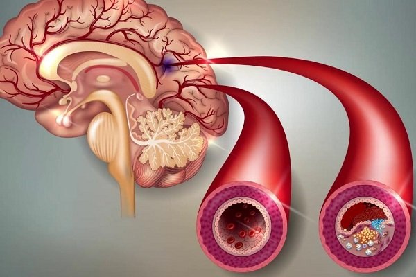 Отложение бляшек холестерина в сосудах головного мозга