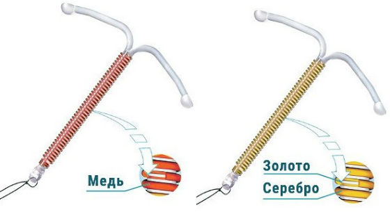 Спираль от беременности. Фото, виды, стоимость, как работает, как ставят