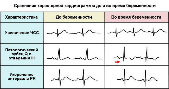 экг беременной