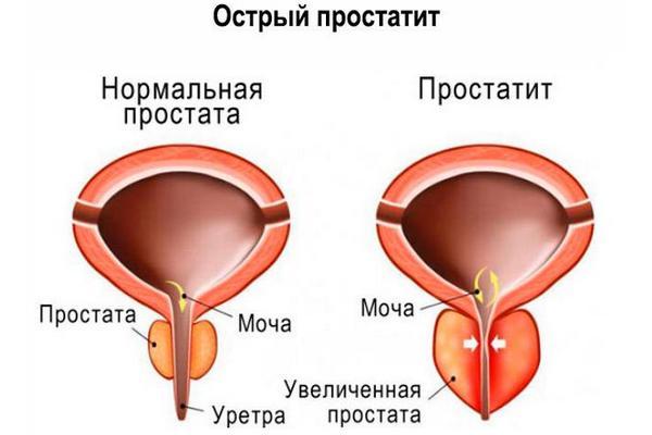 Острый простатит