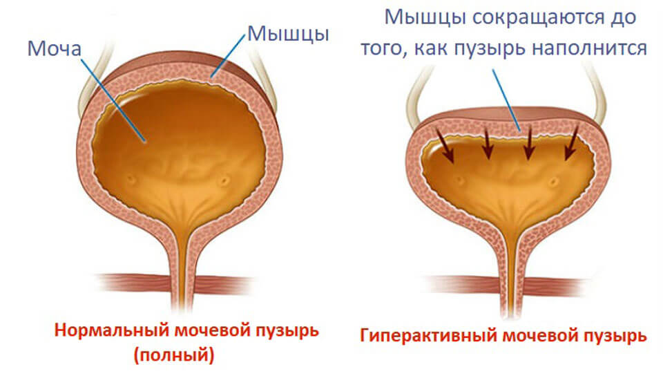 Болит мочевой пузырь у женщины