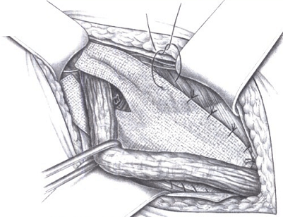 Подшивание сетки к внутренней косой мышце