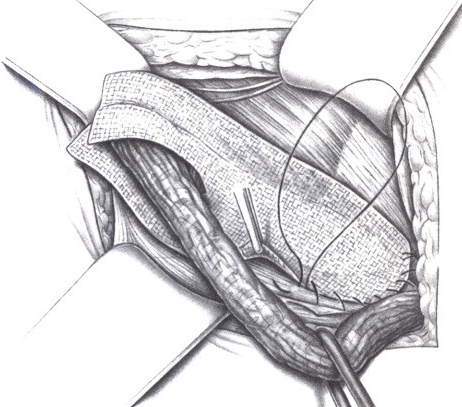Схема герниопластики по Лихтенштейну (сверху удерживают семенной канатик, идущий в яичко)