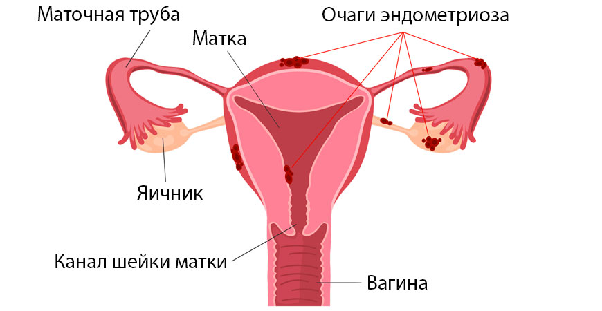 Эндометриоз