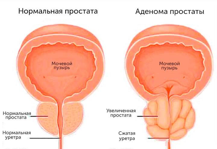 Аденома