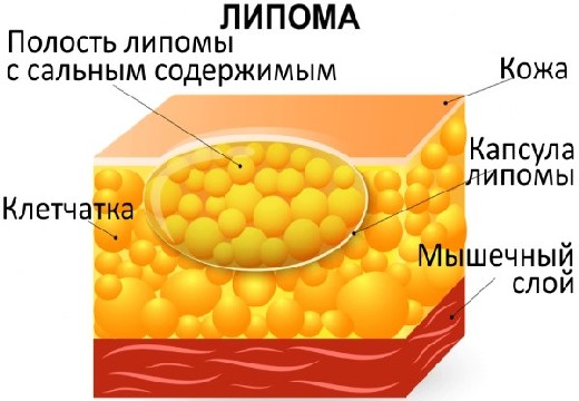 строение липомы