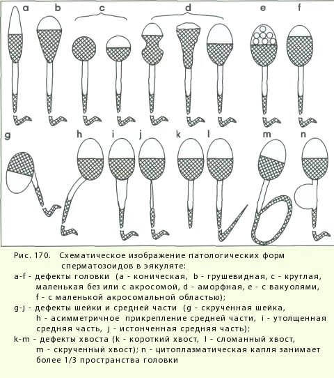 Что такое тератозооспермия у мужчин в спермограмме