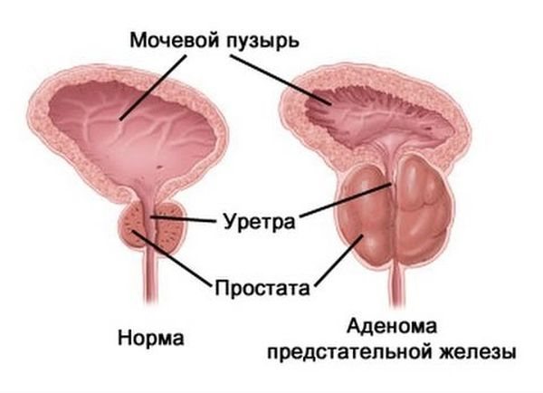 Как выглядит аденома предстательной железы