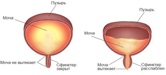 нейрогенная дисфункция мочевого пузыря