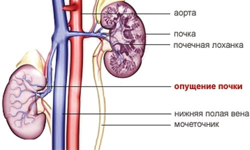 Опущение почки