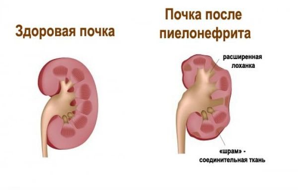 Почка при пиелонефрите