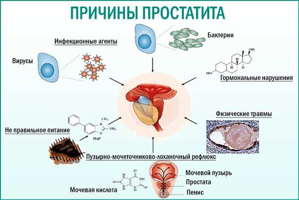 Простатит как причина частого мочеиспускания мужчины