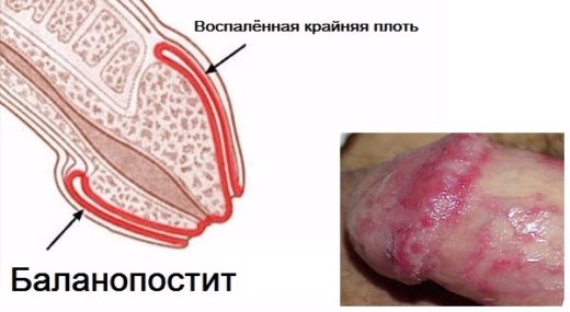 Проявления баланопостита