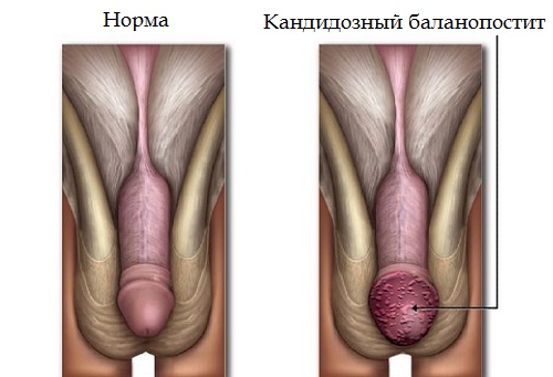 Симптомы кандидозного баланопостита