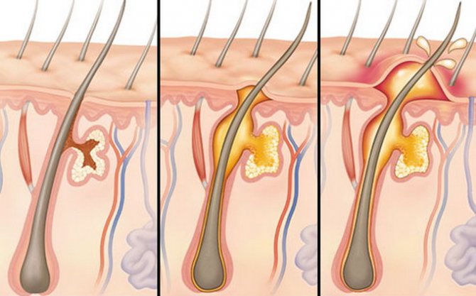 Стадии развития фурункула