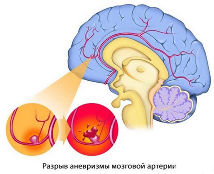 У кого возникает церебральный атеросклероз