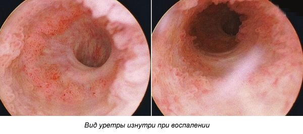 Вид уретры изнутри при воспалении