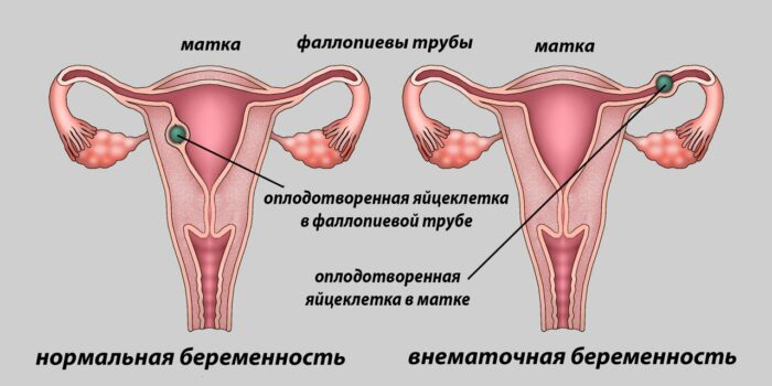 внематочная беременность