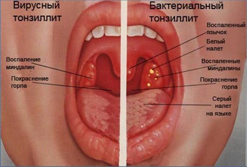 заболевания миндалин