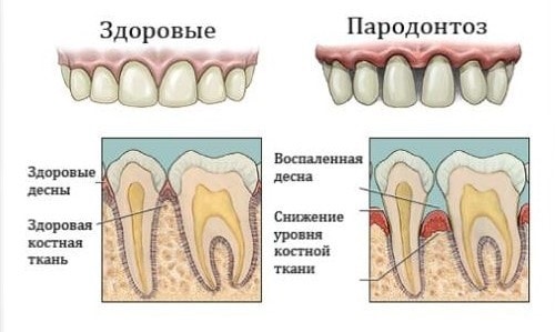 Пародонтоз